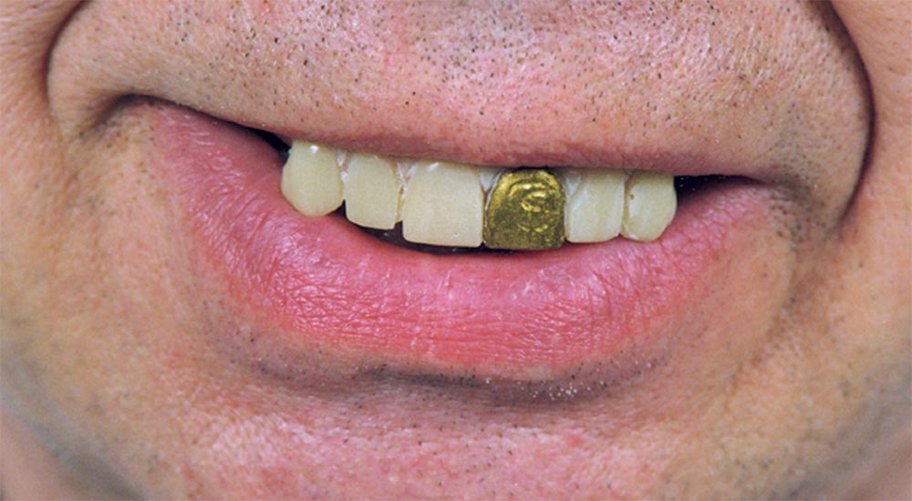 Gold Miner Teeth